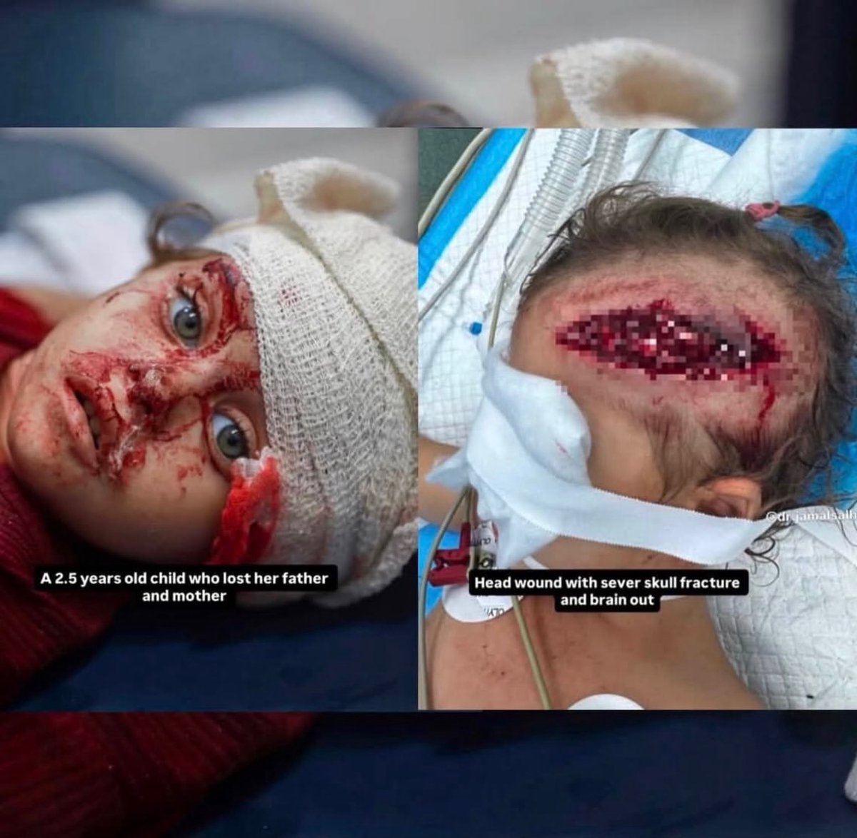 gazanotice's tweet photo. ⚠️Sensitive Content ⚠️
🚨This is what Israel is doing to Gaza’s children, even during the so-called ceasefire‼️

A child undergoes emergency surgery after suffering devastating injuries from an Israeli attack.

documented by Dr. Jamal Salha - two days ago.
23.07.2026