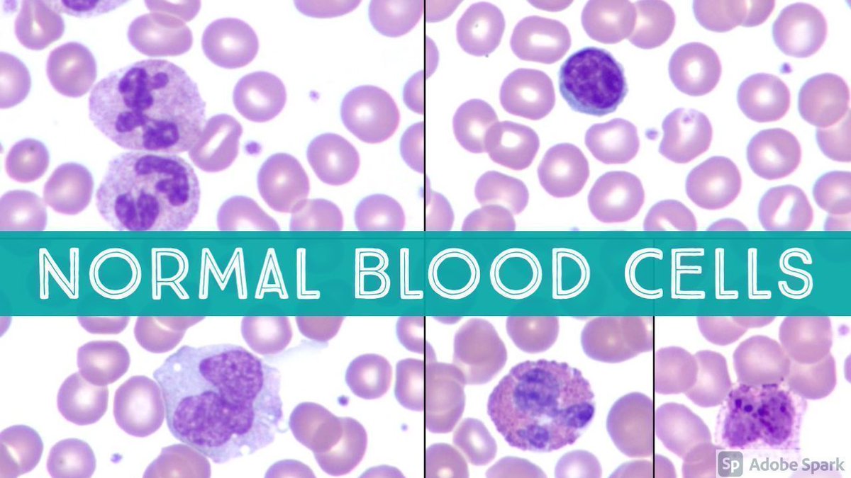 JMGardnerMD's tweet photo. Need to brush up on normal blood cell morphology? This video by my friend Dr. Jeanette Ramos of @ HemepathUAMS is GOLD! https://t.co/zsBN8m5RL4 
#hemepath #pathologists #pathology #pathTwitter #MedTwitter #hematology #heme #MedStudentTwitter #Medstudent https://t.co/UiVLWMNFye