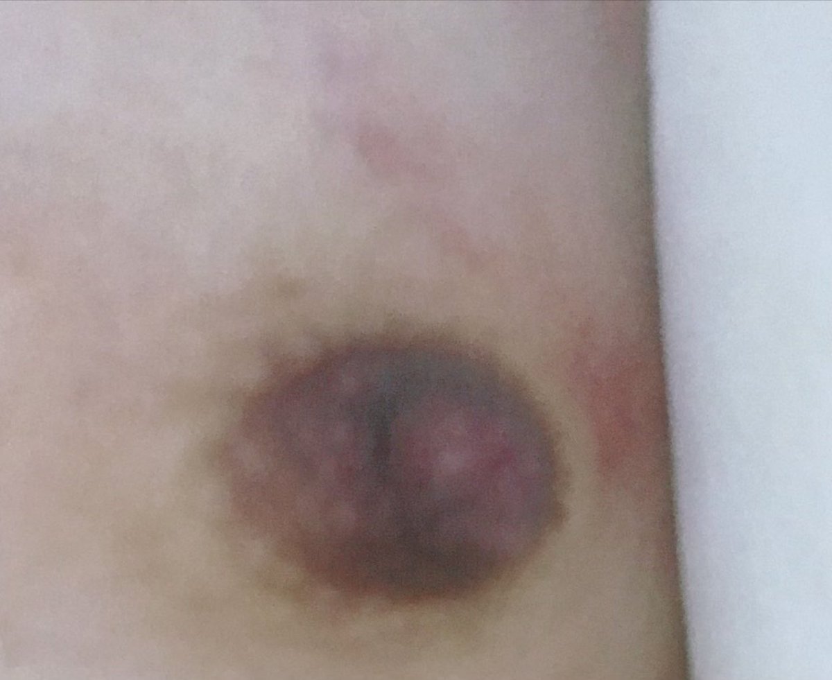 anan_anyu's tweet photo. 乳首しゃぶるために皮膚引っ張りすぎたからあざできてる笑

#乳首
#チクニー
#乳首オナニー https://t.co/ismsd0HoKh