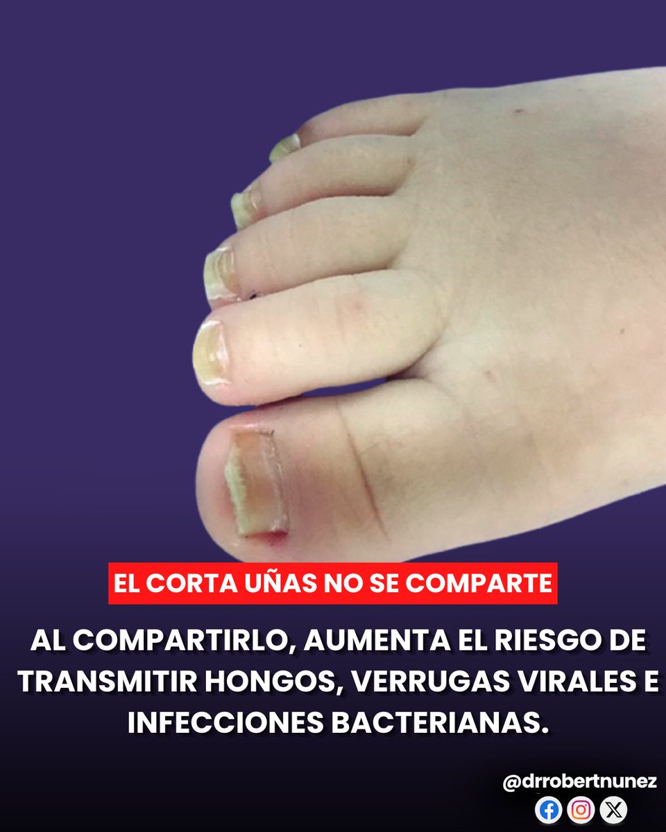 drrobertnunez's tweet photo. ✂️ El cortaúñas no se comparte.

Cada vez vemos con más frecuencia niños pequeños con hongos en los pies y en las uñas. Aunque existen varios factores que favorecen estas infecciones, muchos de ellos pueden prevenirse con hábitos sencillos.

El cortaúñas puede quedar contaminado con restos microscópicos de piel, uñas e incluso pequeñas cantidades de sangre. Al compartirlo, aumenta el riesgo de transmitir hongos, verrugas virales e infecciones bacterianas.

Para cuidar los pies de los niños y las niñas:
👟 Siempre que sea posible, es preferible utilizar calzados abiertos o bien ventilados antes que zapatillas cerradas durante muchas horas, ya que el calor y la humedad favorecen el crecimiento de los hongos.
🧦 No compartas medias.
👞 No compartas zapatos ni calzados.
🛁 Después de cada ducha, secá muy bien los pies, especialmente entre los dedos, ya que la humedad favorece la aparición de hongos.
✂️ Cada integrante de la familia debe tener su propio cortaúñas.

Si por alguna razón el cortaúñas debe utilizarse en otra persona, es indispensable desinfectarlo correctamente con alcohol al 70% antes y después de cada uso.

🩺 Estos pequeños hábitos pueden hacer que tu hijo o hija crezca con pies sanos y evite padecer infecciones por hongos ahora y también en la vida adulta. La prevención siempre será el mejor tratamiento.

#Pediatría #Prevención #SaludInfantil #Hongos #Higiene #CuidadosEnCasa