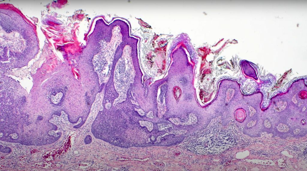 JMGardnerMD's tweet photo. Can you make diagnosis from one low power pic? 
What is the diagnosis (or perhaps diagnosES)? 
Answer ✅ https://t.co/rBJgKpgyWf 
#pathology #pathologists #pathTwitter #dermpath #dermatology #dermatologia #dermtwitter https://t.co/RlBfikVv4f