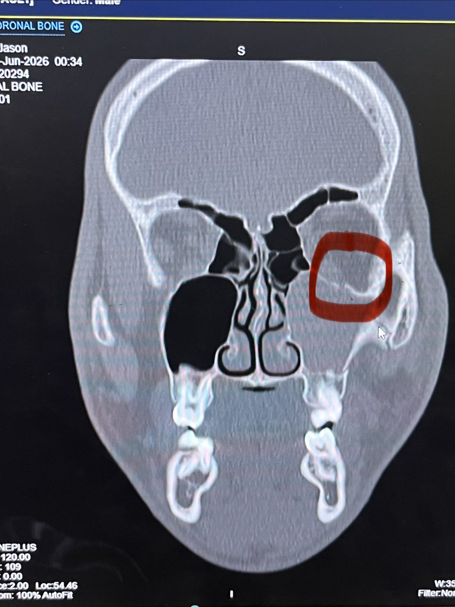 jasonkoziol2028's tweet photo. Four weeks ago today, I got hit by a pitch in the face which resulted in 3 fractures (orbital and maxilla). Luckily, no surgery or jaw wiring needed and no permanent damage. Today… I’M BACK on the diamond (with restrictions)! https://t.co/dQqsSJ7ZOO