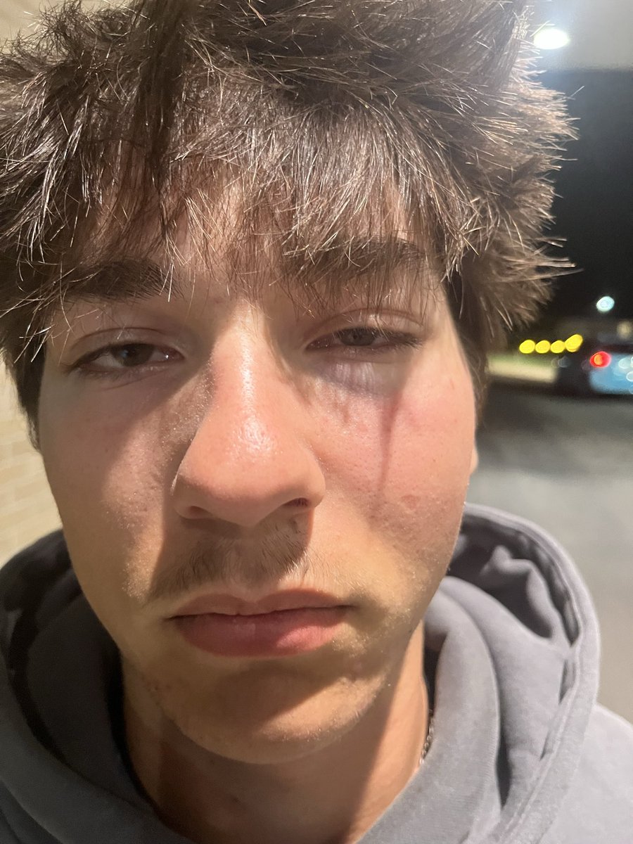 jasonkoziol2028's tweet photo. Four weeks ago today, I got hit by a pitch in the face which resulted in 3 fractures (orbital and maxilla). Luckily, no surgery or jaw wiring needed and no permanent damage. Today… I’M BACK on the diamond (with restrictions)! https://t.co/dQqsSJ7ZOO