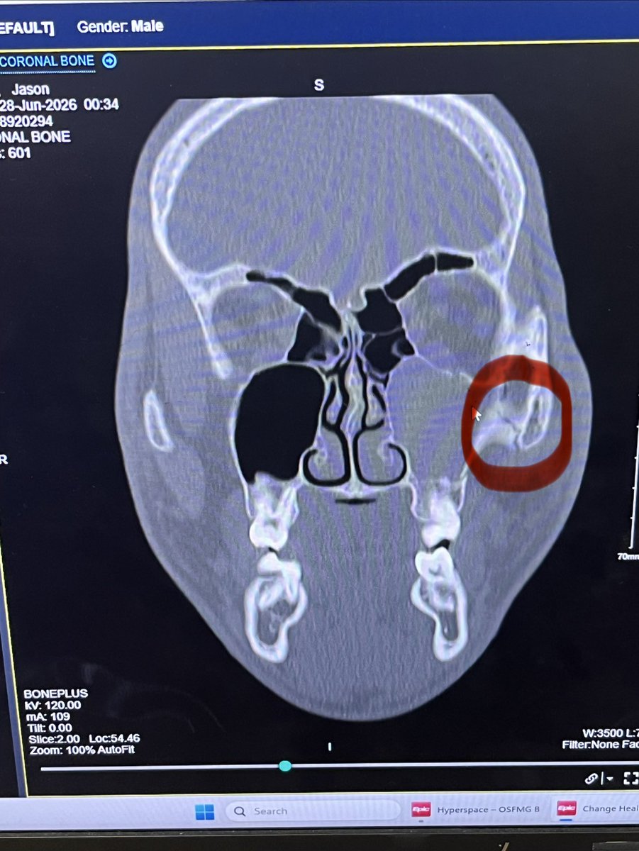 jasonkoziol2028's tweet photo. Four weeks ago today, I got hit by a pitch in the face which resulted in 3 fractures (orbital and maxilla). Luckily, no surgery or jaw wiring needed and no permanent damage. Today… I’M BACK on the diamond (with restrictions)! https://t.co/dQqsSJ7ZOO