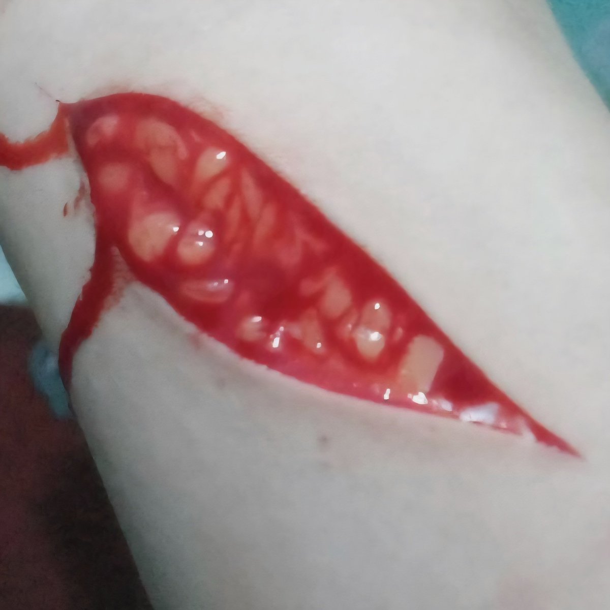 Richellw4h's tweet photo. I had to sew but look at the beans my brother made! He also had to sew :(

@cigarro_p :3

#beanstwt #shtwt #edgtwt #selfharm 

(FAKE SITUATION, FAKE BLOOD) https://t.co/JlCvqyhlAa