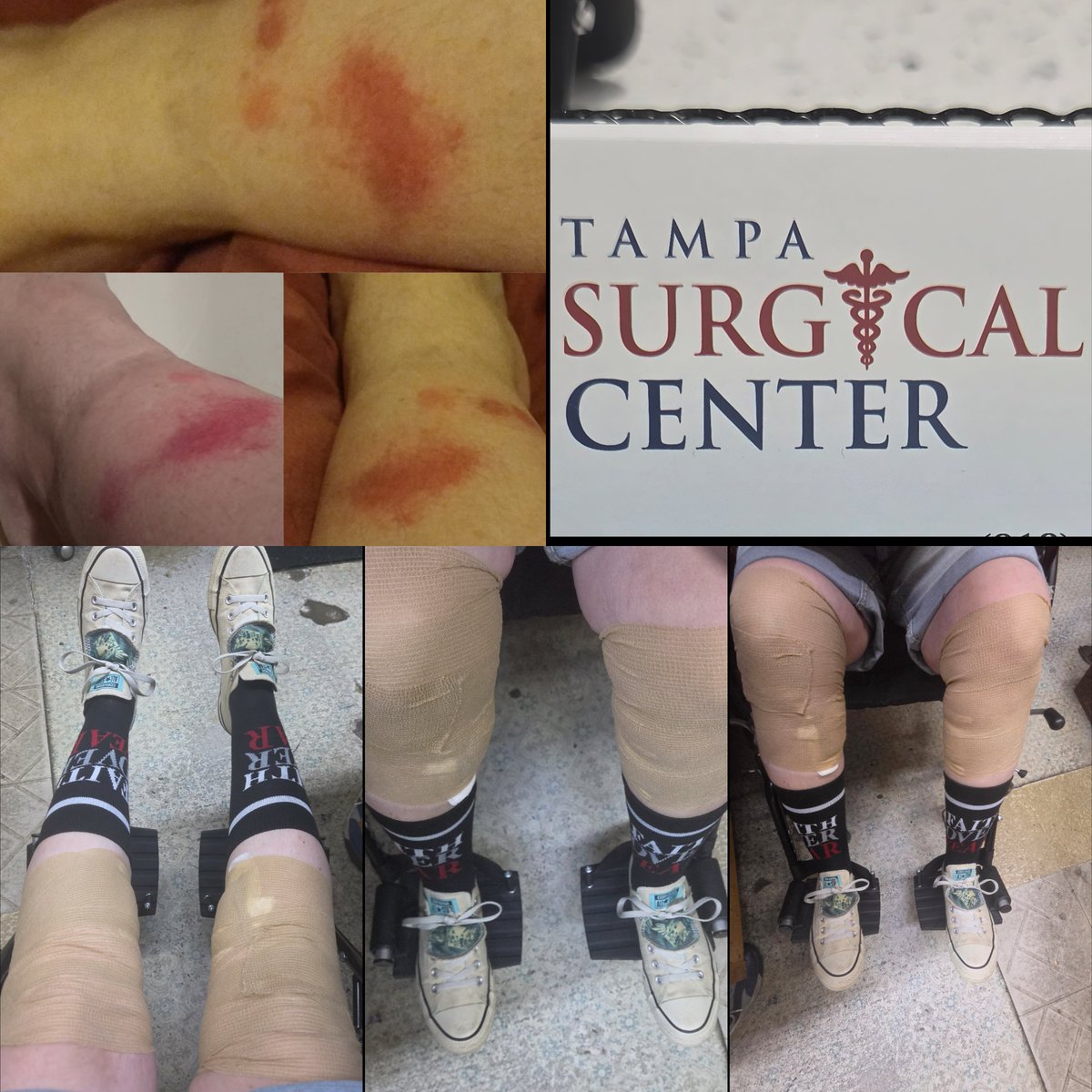 HoldingOntoHope's tweet photo. After 7 years of living with chronic venous insufficiency, I finally had endovenous thermal ablation on both of my legs today. The procedure went well, and now the recovery begins. I'm hopeful this will finally bring some relief. https://t.co/Peq7bqA2Bj
