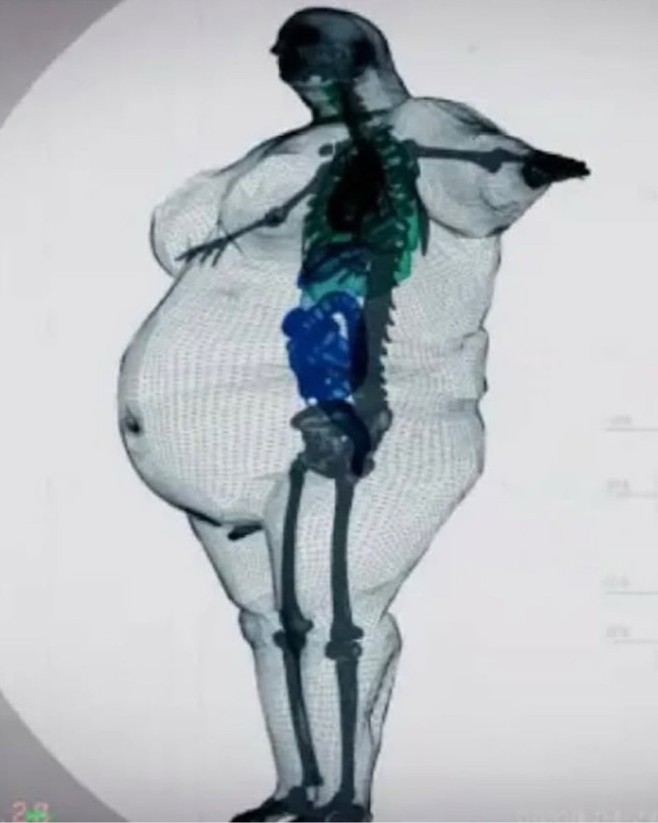 awkwardgoogle's tweet photo. What a skeleton looks like inside an obese person https://t.co/vpYmUpHJpI