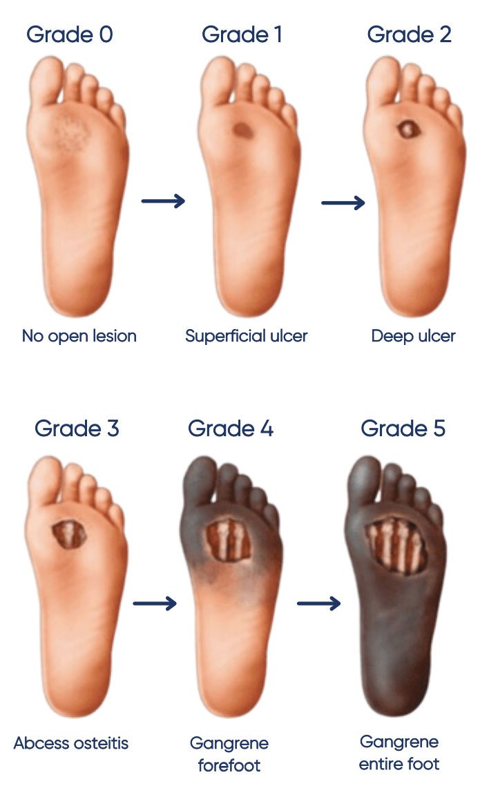 MedicalNews07's tweet photo. This is why diabetic patients should never ignore their feet. 🦶⚠️ https://t.co/1H4UPE5yWB