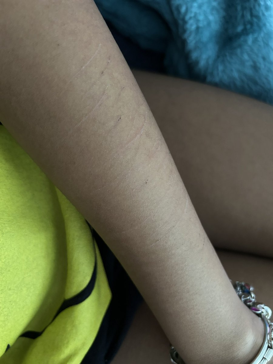 ikedahatesuu's tweet photo. idk if these cat scratches/scars r good enough but take this
sfx makeup, everything is fake!! dont slime me twitter 🥹
#shedtwt #shtwt #slittwt https://t.co/Pt1KYjeW30