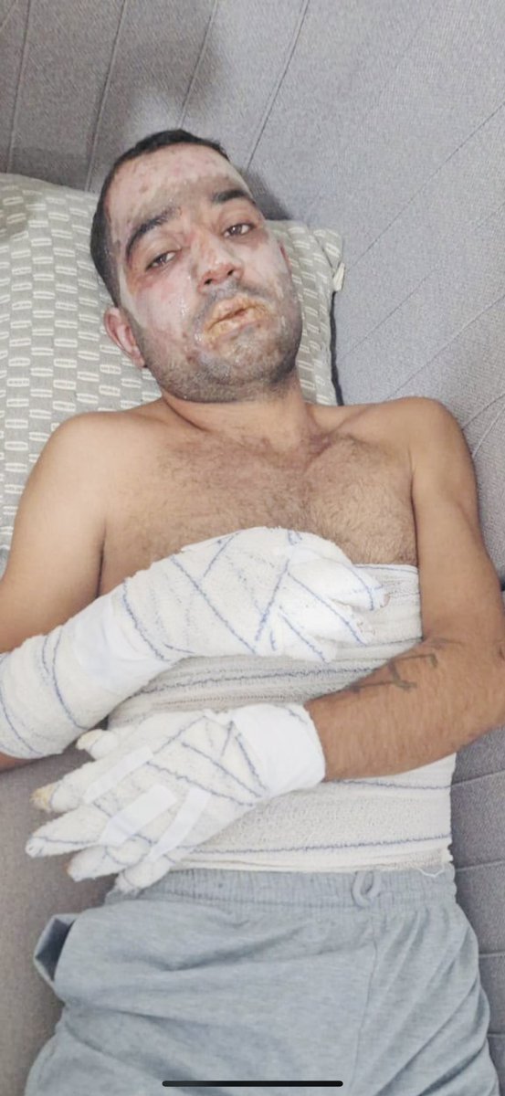 Judy20255's tweet photo. Iran + Turkey = Terrorism

The video shows a Kurdish child injured during the Turkish occupation’s shelling of the city of Serekaniye (Ras al-Ayn) with white phosphorus, a weapon prohibited under international law, in 2019.

The photo, meanwhile, shows a Kurdish Peshmerga fighter injured as a result of the Iranian government’s shelling of the city of Sulaymaniyah with white phosphorus, another weapon prohibited under international law.

#StopUsingBannedWeaponsInKurdistan #JusticeForKurdistan