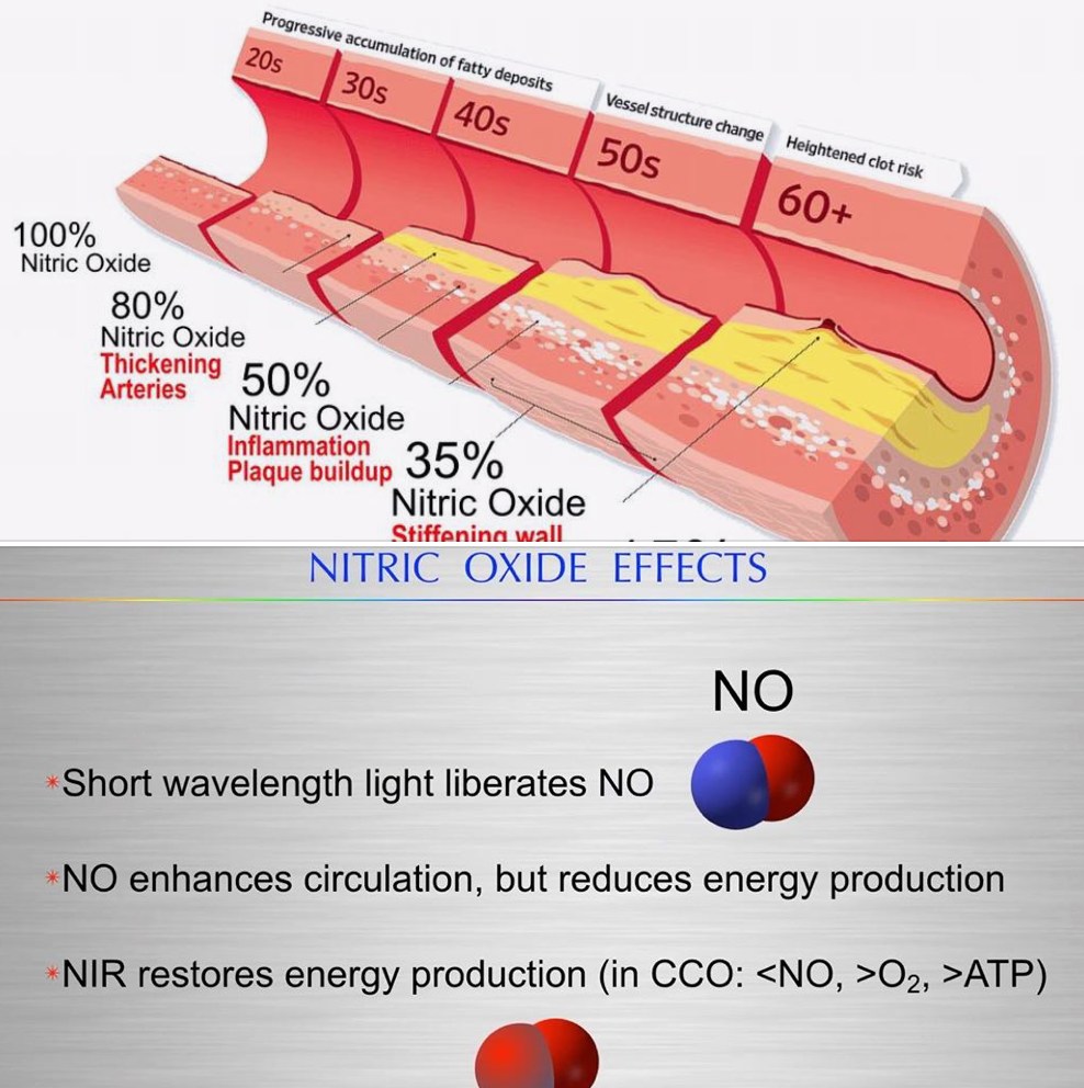 DrJackKruse's tweet photo. No mystery.  

The progressive decline in endothelial Nitric Oxide (eNOS) production, dropping from 100% in your 20s to 35% in your 50s, is not an arbitrary chronological decay. It represents a systematic, quantum-level collapse of the endothelial glycocalyx and inner intimal wall, directly driven by electronic stalling, forbidden spin-flips (ISC failure), and a resulting hyper-ubiquitination cascade.

NO is paramagnetic just as triplet oxygen is.  If ISC fails for any reason, vessel disease is the results because the entire vessel wall is is made from CISS chemicals that rely on ISC physics.  

Funny I did not hear any of that in the podcast from either one of you.  

BIOPHYSICAL FACTS I ALSO DID NOT HEAR

1. The Glycocalyx as the Primary Dielectric Shield. 
The glycocalyx acts as a macroscopic transducer of shear stress. As blood flows, it bends the glycocalyx hairs, generating a localized piezoelectric current that signals eNOS to synthesize Nitric Oxide (NO) and maintain vascular compliance.  Because it is packed with highly organized, negatively charged sulfate groups, the healthy glycocalyx serves as a high-capacity dielectric capacitor. It keeps positively charged particles and circulating native LDL physically repelled from the delicate endothelial intima.

2. How does circadian biology impact the ISC story?  
Under proper circadian solar exposure, short-wavelength light liberates NO into the bloodstream to dilate vessels, while Near-Infrared (NIR) light strikes CCO to selectively break the NO-enzyme bond (<NO). This allows paramagnetic triplet oxygen (^3O2) to cleanly enter the engine, restoring optimal ATP synthesis (>O2 >ATP).

The Diamagnetic Collapse: Without the proper circadian input of solar NIR wavelengths to continuously purge NO from CCO, the mitochondrial engine remains chronically blocked. Electrons backing up behind the NO-choked CCO complex are forced into an Intersystem Crossing (ISC). This spin-flip converts safe, paramagnetic ground-state oxygen into highly destructive, diamagnetic singlet oxygen (^1O2).

3. Once diamagnetic singlet oxygen is unleashed inside the endothelial cells due to this circadian uncoupling, the structural decay of the vessel wall accelerates rapidly.  Diamagnetic singlet oxygen directly oxidizes the core proteins (like syndecans and glypicans) of the glycocalyx, stripping away the endothelial layer's protective negative charge.

What happens if someone occassional grounds or gets a it of sun?  They do not have the same phenotype of disease as the patients who always break the rules of Nature. 

4. The structural collapse of these oxidized, damaged intimal proteins flags the immediate activation of E3 ubiquitin ligases. The cell is forced to rapidly upregulate ubiquitination rates to mark the degraded glycocalyx fragments and structural matrix components for proteasomal disposal. This massive protein-turnover tax drains the localized energy pool, permanently lowering baseline eNOS output.  

With the negative dielectric shield of the glycocalyx dissolved, the electrostatic barrier is gone. Native LDL particles freely diffuse across the compromised endothelial barrier into the sub-endothelial space. Trapped within an intimate matrix that is actively bleeding ultraweak photons (UPEs) from singlet oxygen decay, the native LDL is instantly chemically modified into oxidized LDL (oxLDL), unlocking the scavenger receptors on macrophages to form the foam cells and plaque deposits depicted in my slide below in the 40s and 50s timeline.

SUMMARY
Why do people with the same disease have different phenotypes?  

Vascular aging is not a guaranteed linear march toward a 35% NO deficit and stiffened arterial walls. The progressive accumulation of fatty deposits is the direct macroscopic readout of a chronic subatomic brownout.

By utilizing circadian biology to preserve the negative charge of the glycocalyx, and using NIR wavelengths to keep CCO clear of NO blockades, you maintain oxygen in its safe paramagnetic state. This cuts off the intersystem crossing at the pass, prevents the hyper-ubiquitination of the vascular lining, and keeps the endothelial engine young.

I told ya' it was no mystery.