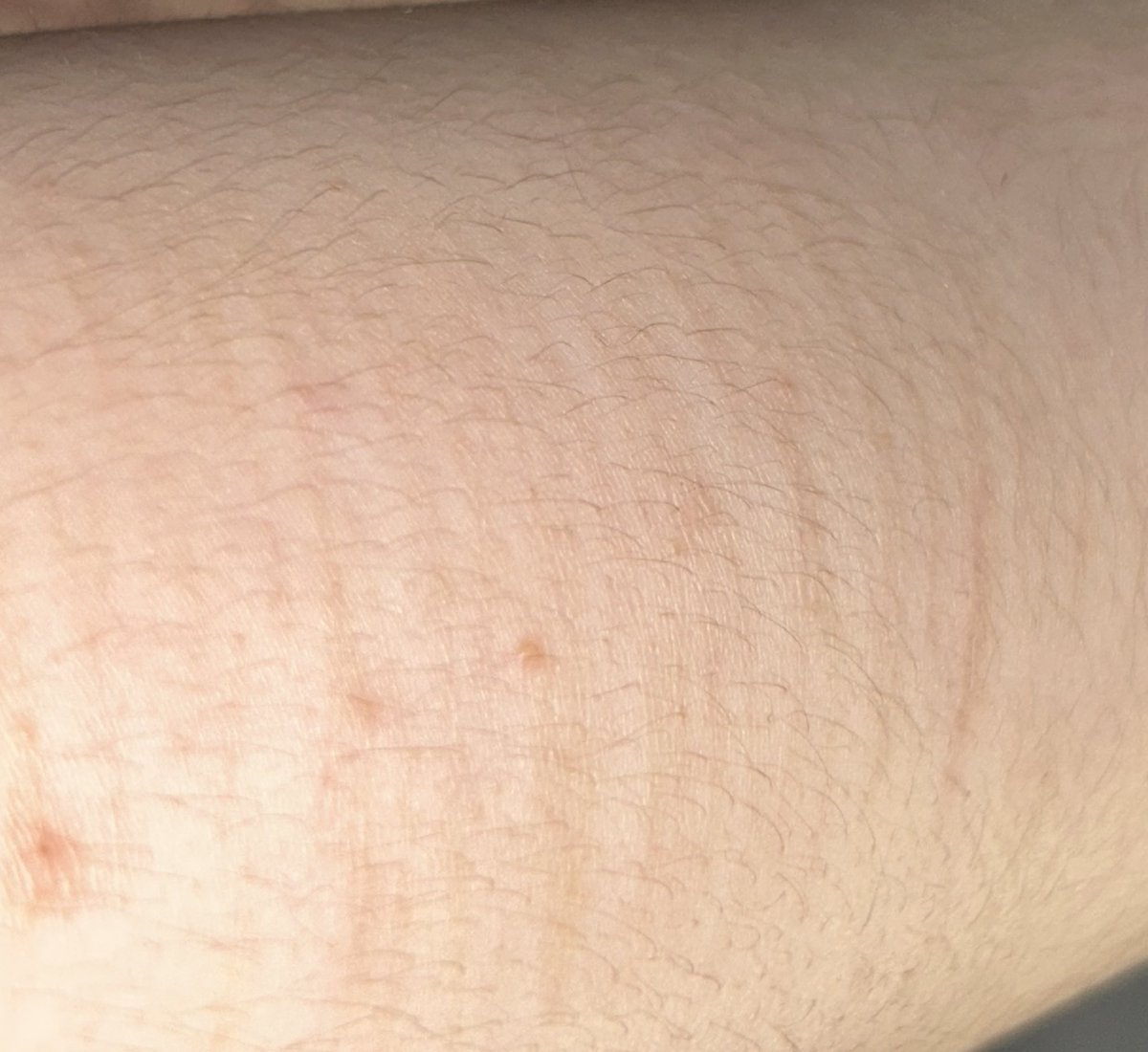 lainlainlainnn's tweet photo. I hate my scars I wish they were more noticeable and I’ve been clean for a month I just want to relapse tf #shtwt #shedtwt #slittwt https://t.co/IEv0wlUjpy