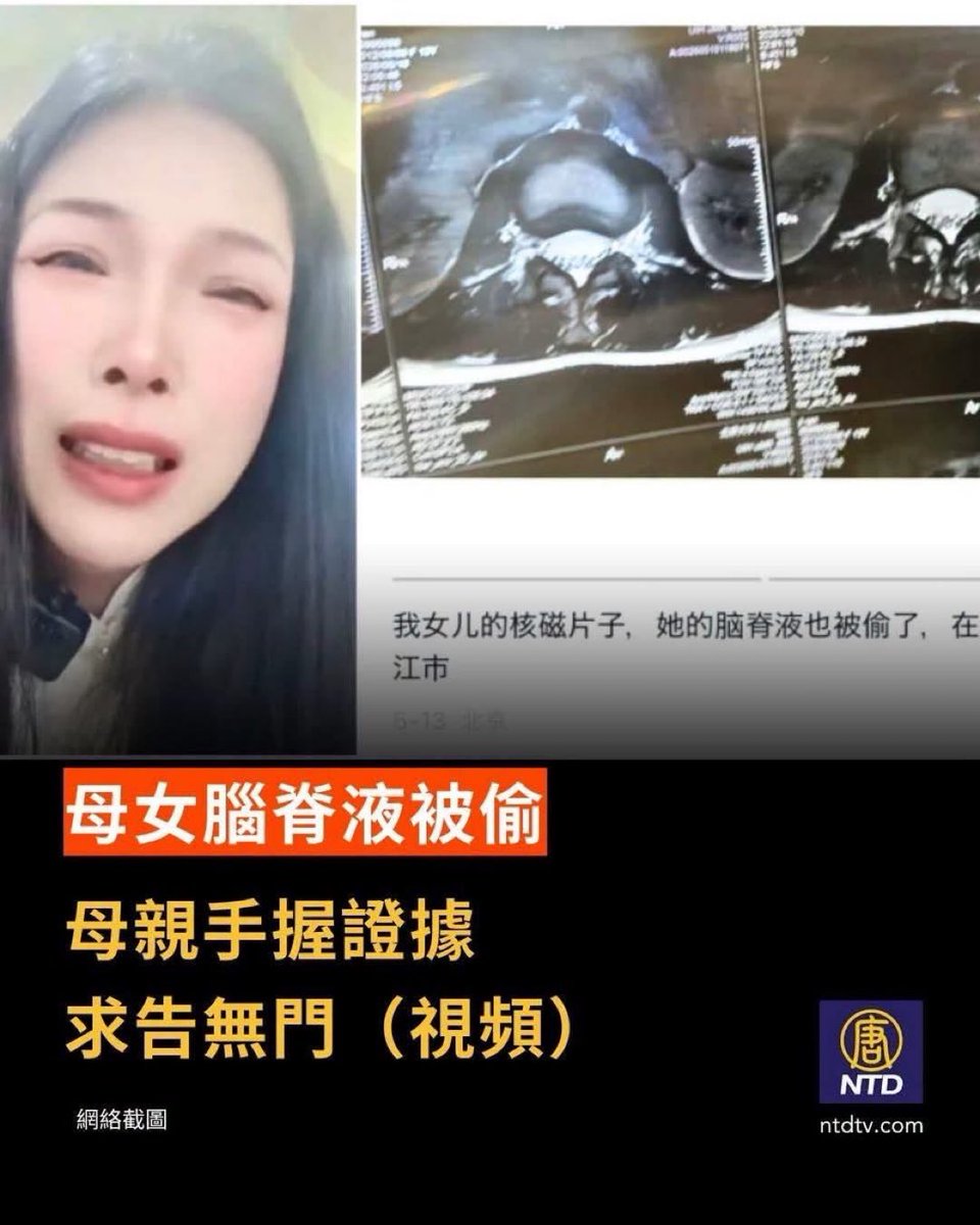 zhihui999's tweet photo. 👇 絕望母親的血淚控訴：
1️⃣ 母女相繼受害： 這位媽媽透露，自己先前因骨折在河南就醫，竟被醫院趁機偷走脊髓和腦脊液。她萬萬沒想到，自己13歲的女兒隨後在江蘇鎮江也遭遇毒手，同樣被偷走了腦脊液！
2️⃣ 命危孩子在掙扎： 媽媽公布了女兒的核磁檢查片子。現在孩子整天不吃不喝，身體無法正常代謝，正在生死線上掙扎。媽媽悲憤質問：「我們普通老百姓就沒有權利活著對嗎？中國還有法律嗎？」她說自己手握證據，卻根本求告無門……