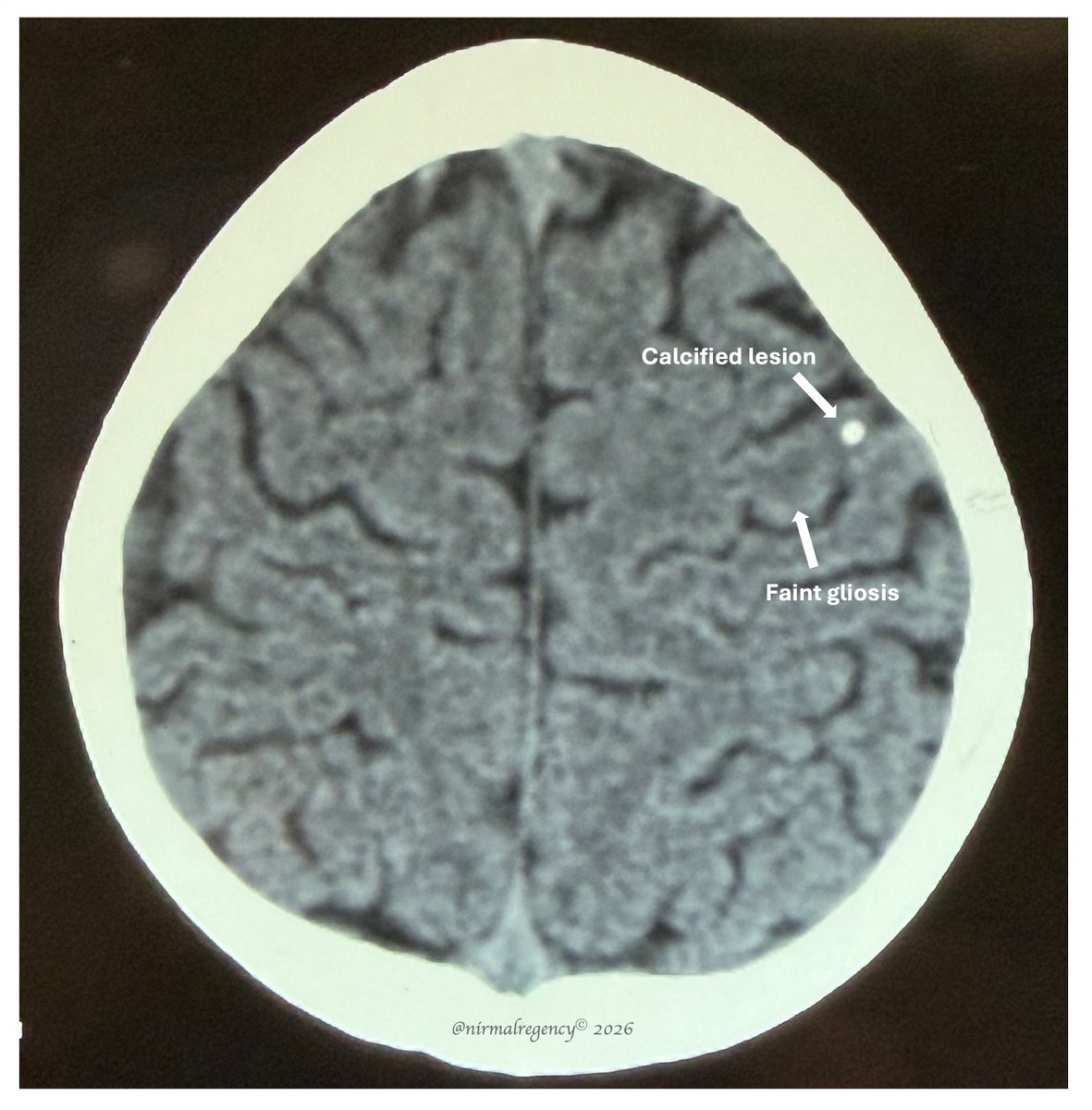 nirmalregency's tweet photo. This 10♂🧒 had an interesting focal seizure semiology x 2 yrs. ⤵️
His hand | finger jerks would start from his 𝓡 thumb & sometimes would stop there, at other times would spread to the other fingers 𝟭 by 𝟭 without LOC: 
The Finger March

MR confirmed the CT findings.