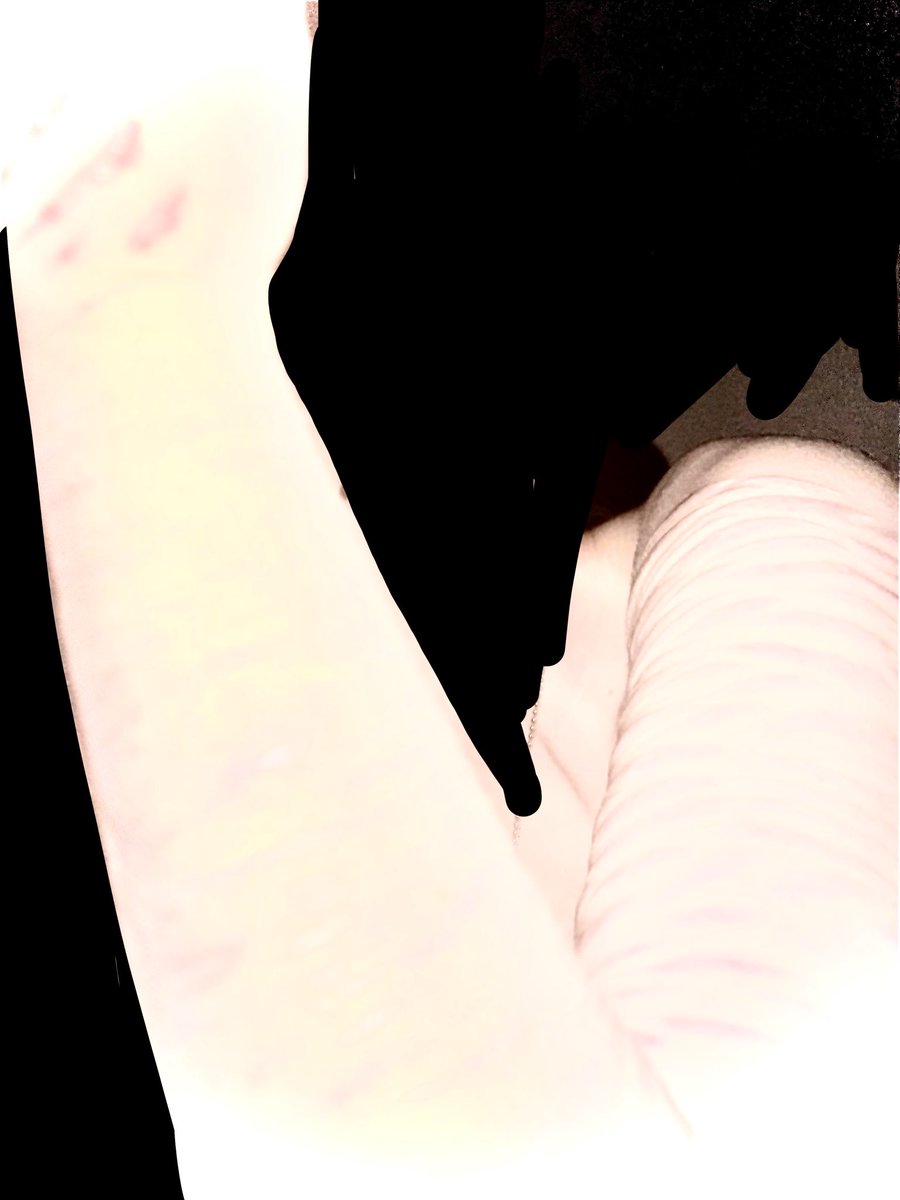 teethareboness's tweet photo. editing is crazy chat. 3 pictures of the same arm. one with no editing, (except for the blacked out spots) one that makes my scars as invisible as possible, (yes ik i look ghostly) and one that makes my scars as bold as possible. ALL FAKE, AI SFX! #scars #shrtwt https://t.co/yb5xIM2huj