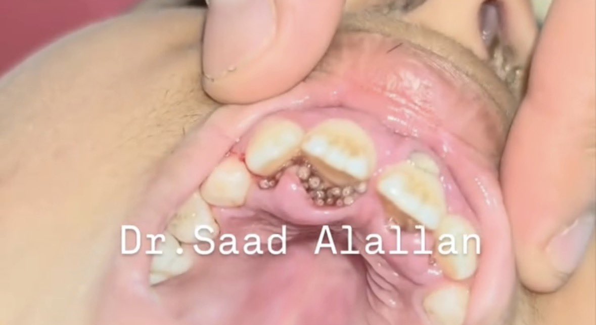 BangferyID's tweet photo. Ini namanya Oral Myiasis yah bub.

Kondisi langka yang jarang terjadi, dimana larva lalat masuk dan hidup didalam mulut. Ini biasa terjadi saat lalat betina bertelur di mulut yang tdk bersih dan bau, ada gigi yang rusak/gigi busuk. https://t.co/pU18Bhr7za