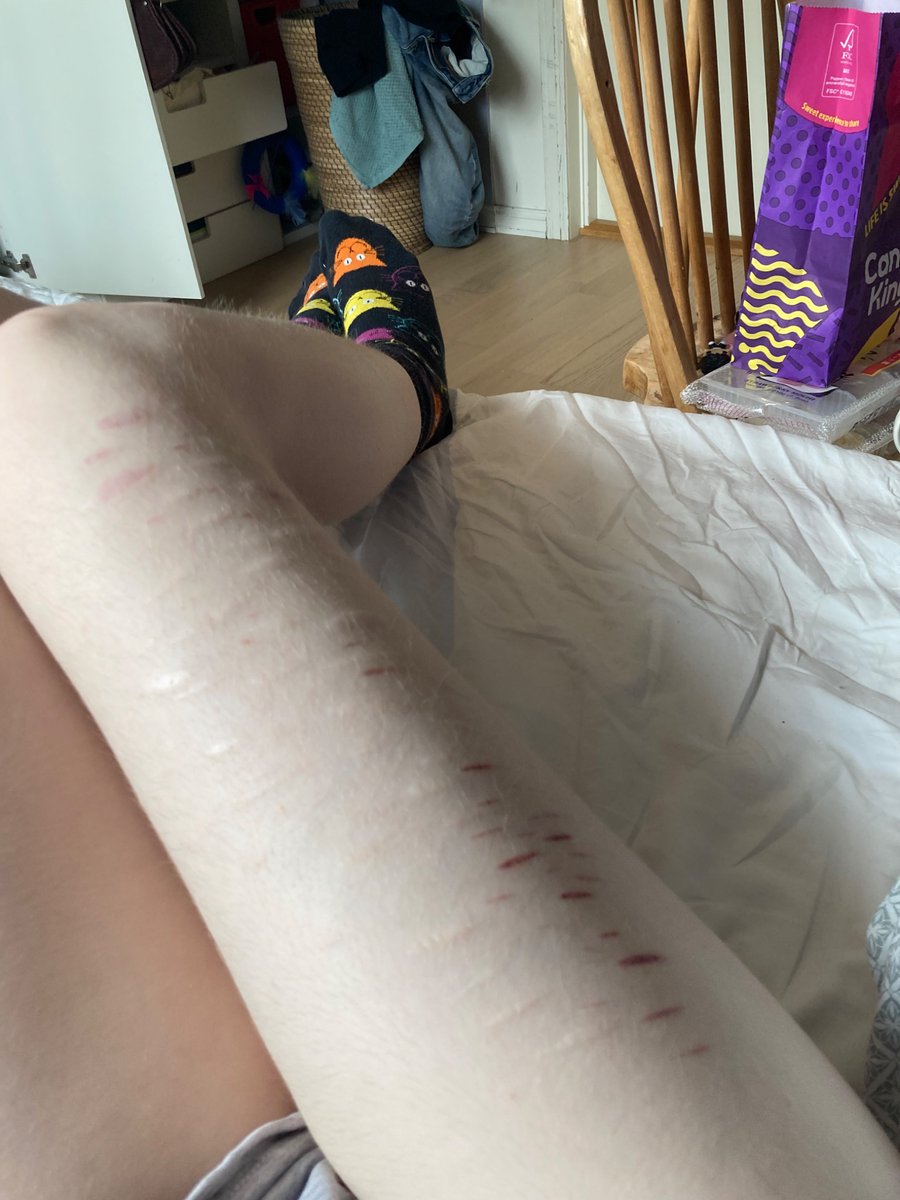 Idek_dudeee's tweet photo. Was going to take a pic of my scars, but ended up just realising how fat I am😭😭 the candy bag in the background too??💔💔 #shedtwt #fatspo #scarspo ALL FAKE SFX AI FOR A HORROR MOVIE https://t.co/2oArbHwHgO
