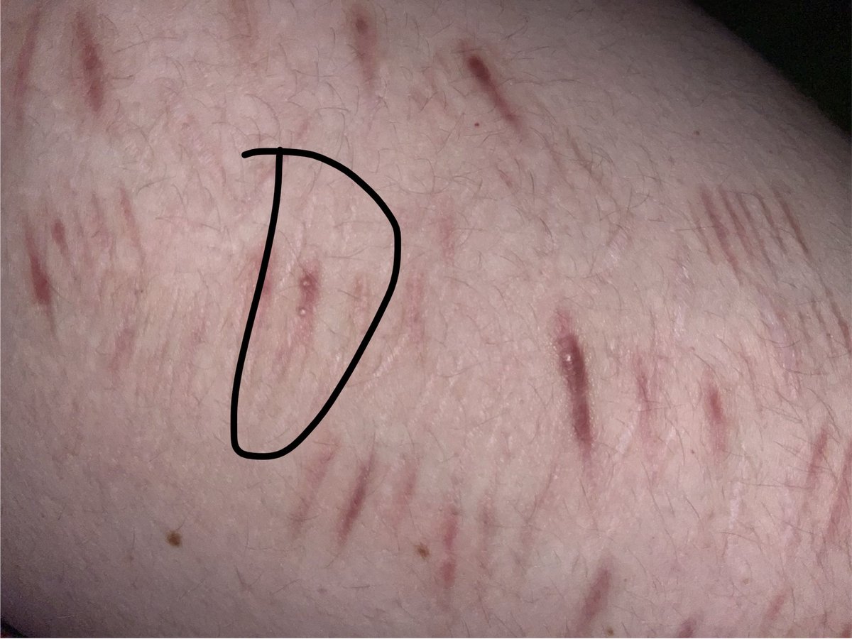 A0ven's tweet photo. Are those fucking PIMPLES on my scar? 😭😭 https://t.co/kOLUNu0CCi