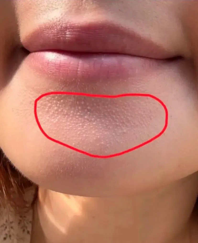nadaeladela's tweet photo. Saran dari dr. SPKK 😭🙏

Ternyata selama ini banyak yang salah exfoliasi bukannya bikin bagus, malah bisa hancurin skin barrier ��🥲
Kalau ga paham cara pakainya, mending STOP dulu.

Begitu dipake dengan cara yang bener, baru kerasa bruntusan pelan-pelan hilang tanpa perih, tanpa drama. Kulit jadi jauh lebih tenang.✨￼