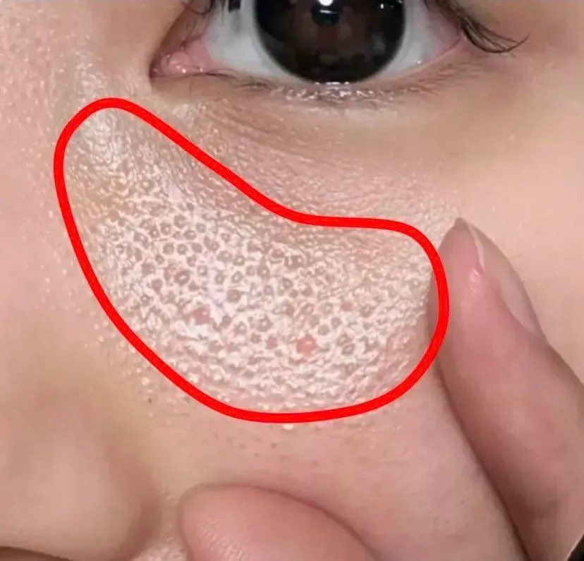 nadaeladela's tweet photo. Saran dari dr. SPKK 😭🙏

Ternyata selama ini banyak yang salah exfoliasi bukannya bikin bagus, malah bisa hancurin skin barrier ��🥲
Kalau ga paham cara pakainya, mending STOP dulu.

Begitu dipake dengan cara yang bener, baru kerasa bruntusan pelan-pelan hilang tanpa perih, tanpa drama. Kulit jadi jauh lebih tenang.✨￼