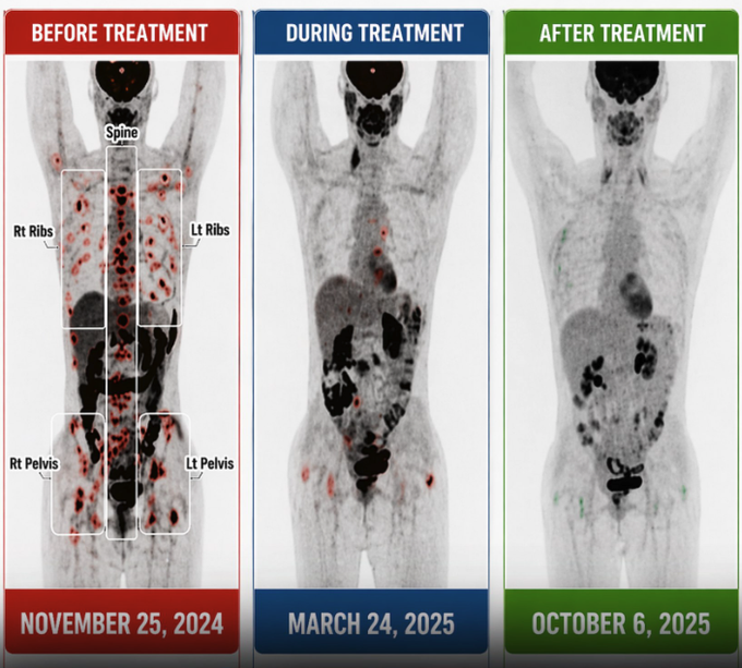 JoeTippens_'s tweet photo. IVERMECTIN and FENBEN Testimonial – 53-Year-Old Utah Woman with Stage 4 Breast Cancer Reaches Remission in 11 Months

Trigger Warning: No chemotherapy, no immunotherapy, no targeted therapy, and no hormone therapy. Only palliative radiation was administered to a few painful bone lesions before starting the alternative protocol.

A 53-year-old woman from Utah was diagnosed with Stage 4 breast cancer.

For 11 months, she followed this regimen:

1. Ivermectin: 60 mg/day (~1 mg/kg)
2. Fenbendazole: 222 mg with MCT oil or other healthy fats (5 days on, 2 days off)
3. Ketogenic diet

For additional details, please refer to the original source.

“Thank you for your vocal endorsement of alternative cancer treatments. It is partly because of your advocacy that a friend/patient has achieved these results.”

“She had Stage 4 metastatic breast cancer and, after 11 months, is essentially cancer-free based on her PET scan.”

“Her results are almost miraculous.”

No chemotherapy. No immunotherapy. No targeted therapy. No hormone therapy.

Source: Oncology guidelines and clinical research standards.
Follow for more updates.

#CancerResearch