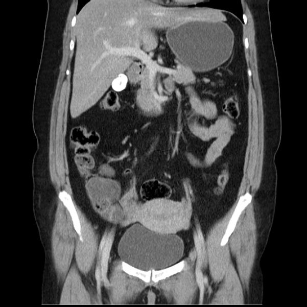 ardhiasaY's tweet photo. Pasien wanita berusia 55 tahun melakukan pemeriksaan CT Scan abdomen dengan keluhan nyeri hebat pada perut bagian kanan atas yang menjalar ke punggung, disertai mual dan muntah setelah mengkonsumsi makanan berlemak.

setelah dilakukan CT Scan, ternyata..
Ada yg tau gambaran apa ini?