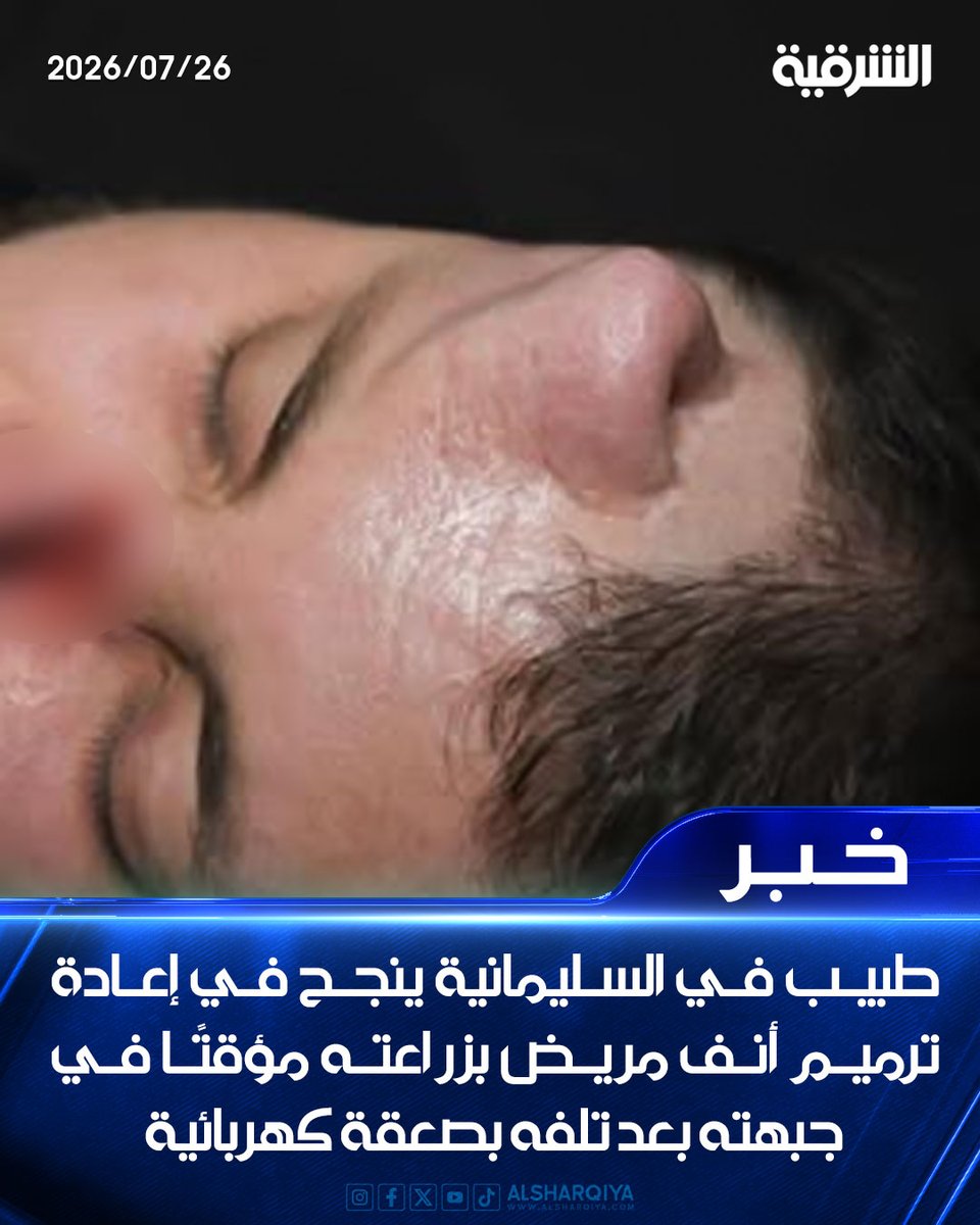alsharqiyatv's tweet photo. طبيب في #السليمانية ينجح في إعادة ترميم أنف مريض بزراعته مؤقتًا في جبهته بعد تلفه بصعقة كهربائية
#الشرقية_نيوز https://t.co/Ode6V06n9m