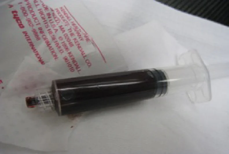 MTDMED's tweet photo. Which condition causes the blood to appear chocolate-brown in color? https://t.co/05PhyiilCL