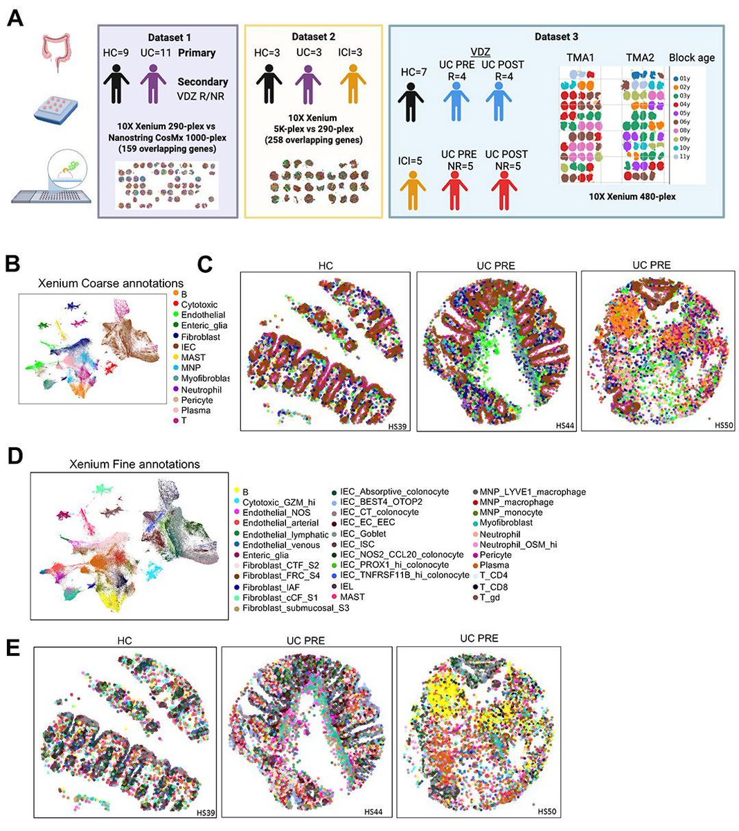 jclinicalinvest's tweet photo. A highlight from last week: Can routine archived clinical biopsies help predict treatment response in ulcerative colitis? https://t.co/GUF0MepRnF

@MikeKattahMD, @alexis_combes & team @UCSFMedicine applied spatial gene mapping to archived colitis biopsies, identifying immune cell neighborhoods that explain why some patients are resistant to vedolizumab and others respond well.
@MayoClinic
#Colitis #IBD