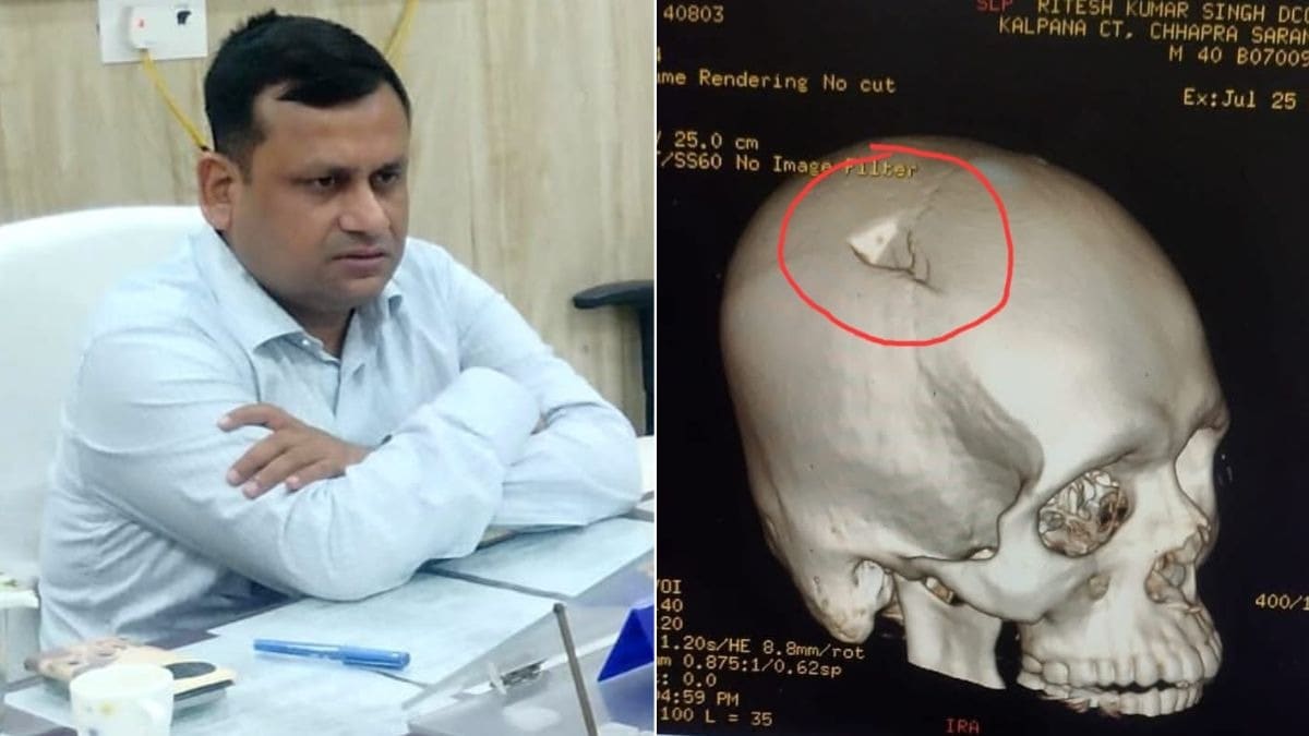 treeni's tweet photo. In Bihar's Chapra, BDO Ritesh Kumar Singh had severe head injuries and a fractured skull, due to stone pelting by "Gen-Z" student protestors of CJP.

He is now in critical condition and battling for his life.

CJP had demanded ALL FIRs against protestors, by Central govt and NDA-ruled states to be withdrawn.