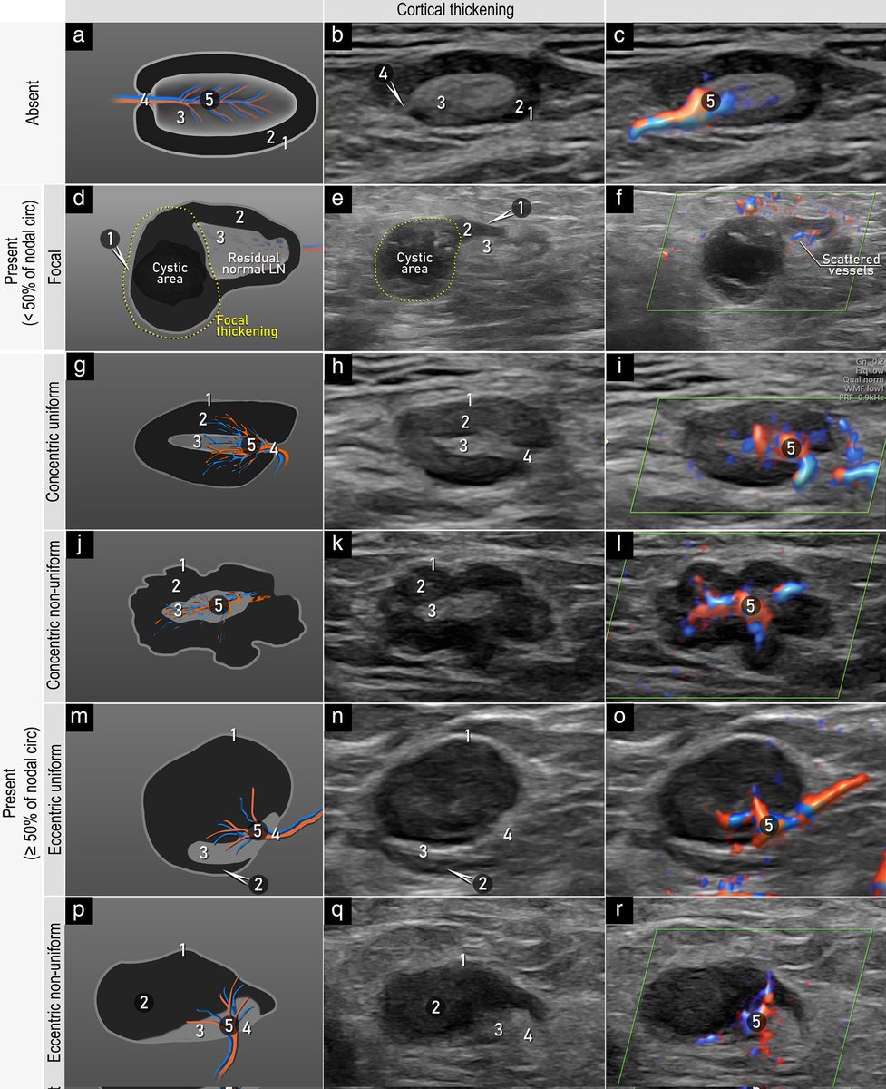 Radblogtv70's tweet photo. Different Ultrasound Morphologies of Lymph Nodes 

#Deciphered https://t.co/WbIOQDWrck