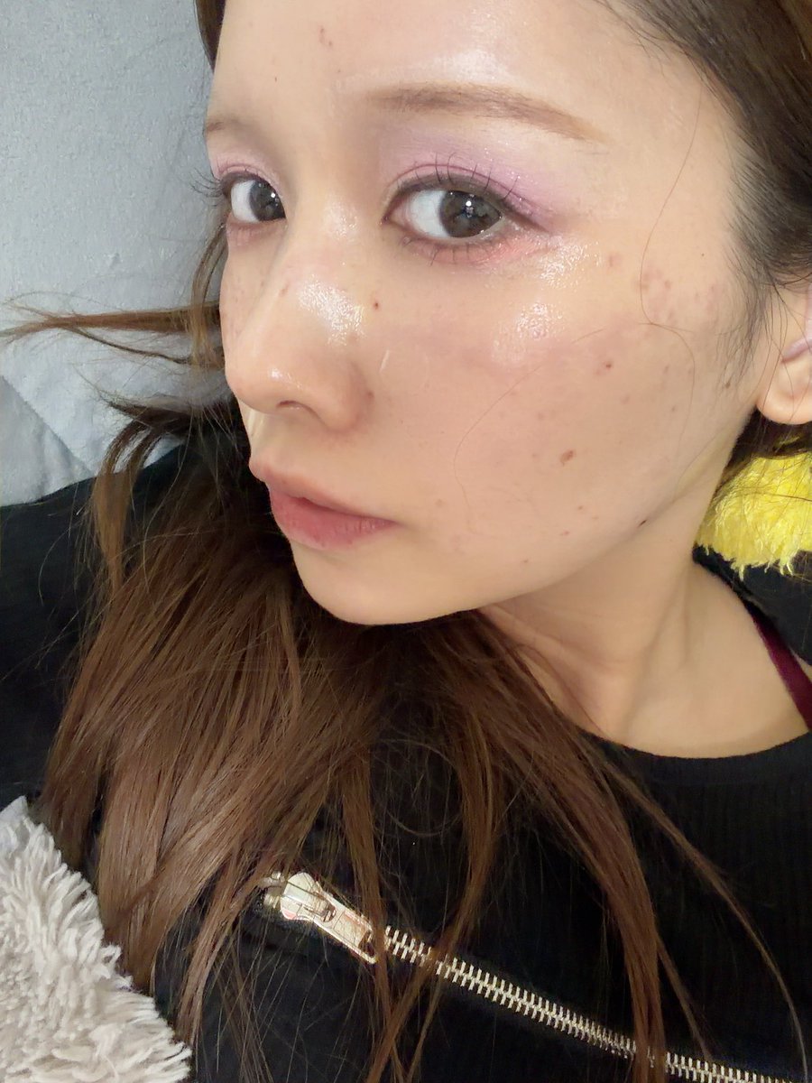 Omochin_da's tweet photo. ピコスポットやったことで加工してもしきれない肌になっている‼️DTはよ終わってくれなあ‼️つかれた https://t.co/VGFkwdttKm