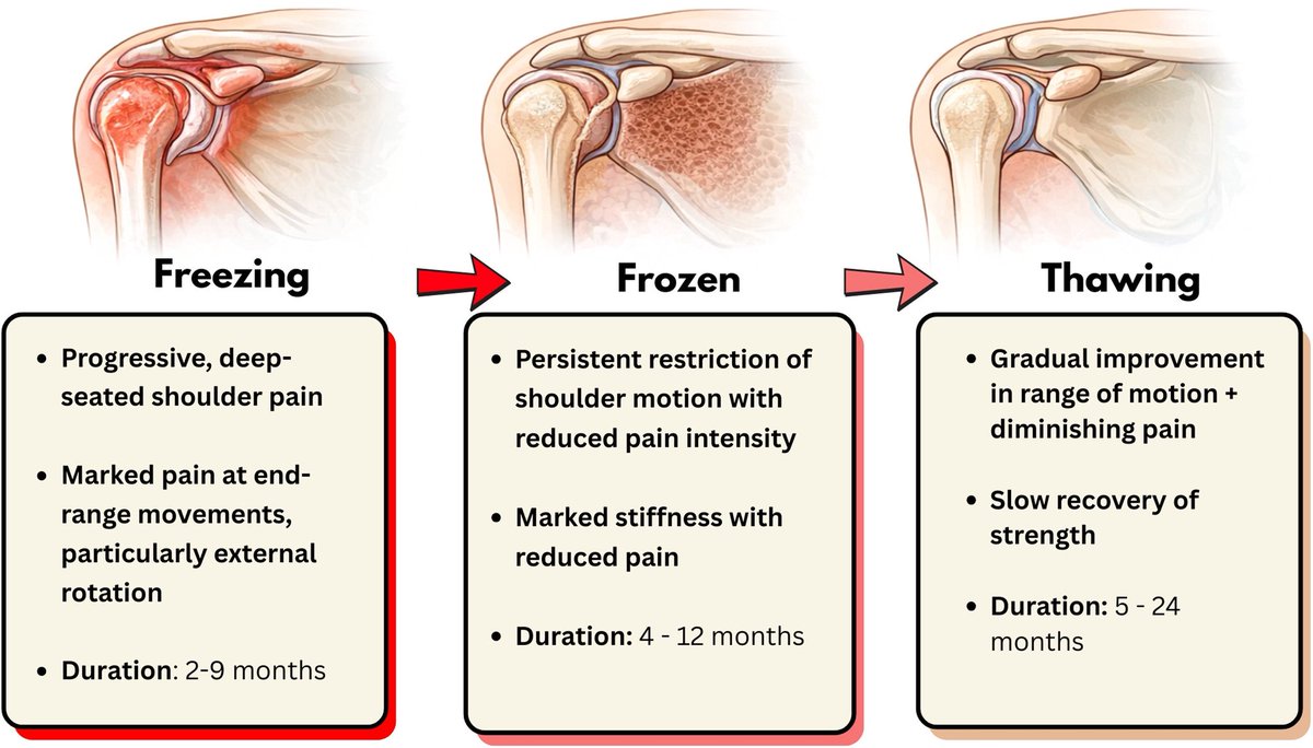 Omid_HopeUni's tweet photo. Frozen shoulder: Diagnosis and treatment of adhesive capsulitis

#shoulder #pain

Clinical staging of Frozen Shoulder👇🏼

https://t.co/PQ1f3s0RSe https://t.co/tg2UARBxo9