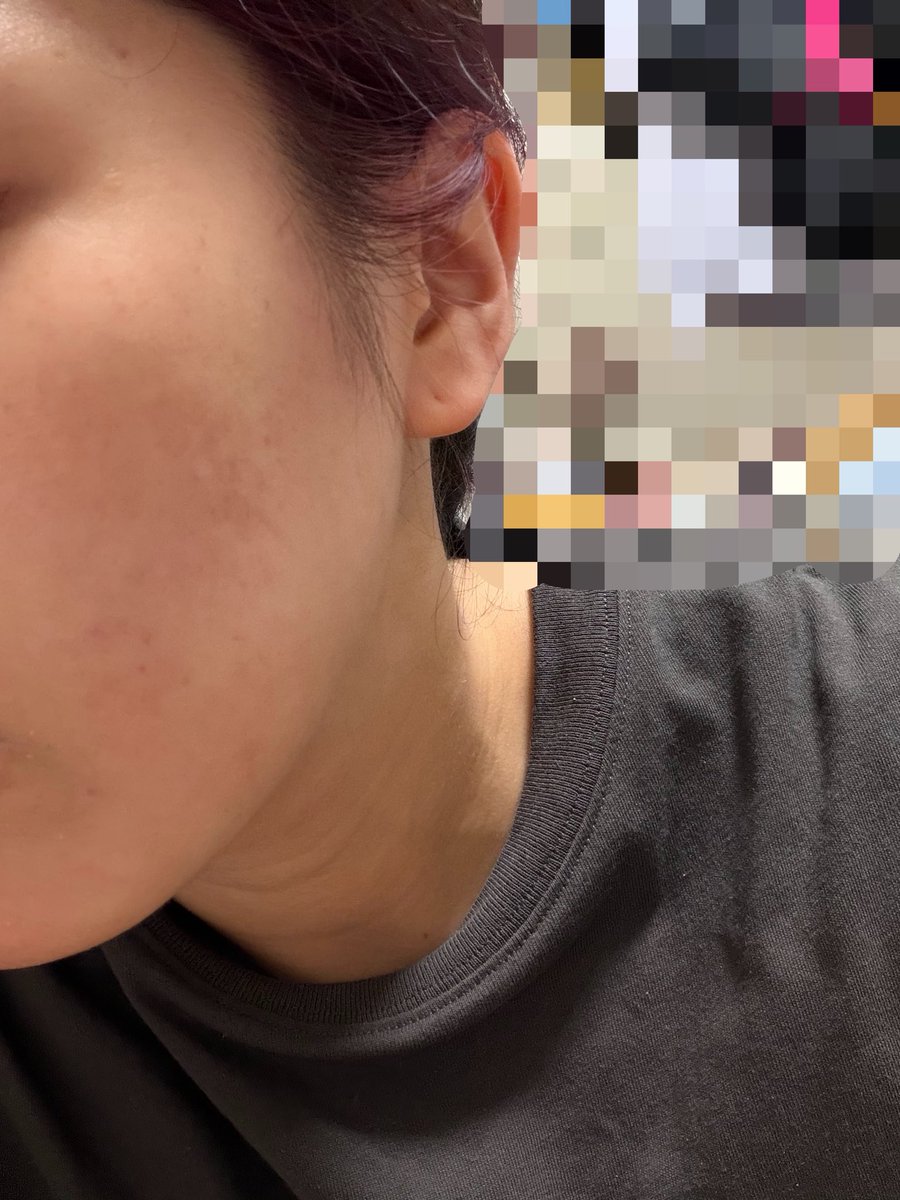 15stsn27's tweet photo. 服薬63日目(2クール目)
1週間くらい新規ニキビなし
しこりニキビ消失
抜け毛もかなり落ち着いた気がする
やっぱりイソは飲み始めて2ヶ月くらい経つと効果出てくる
ただ今回副作用が嫌な感じ
前回と違うとこもあるからまとめる https://t.co/KzANpFHOVz