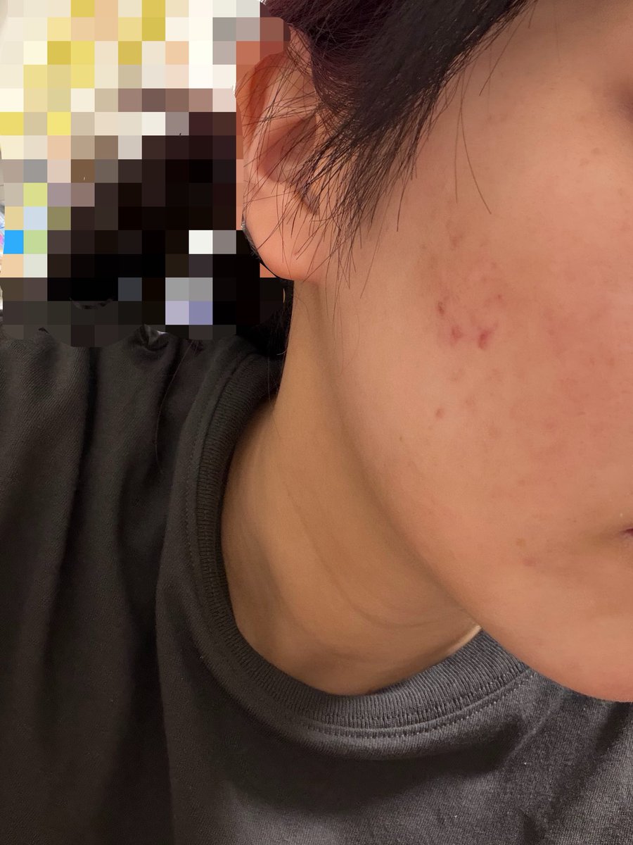 15stsn27's tweet photo. 服薬63日目(2クール目)
1週間くらい新規ニキビなし
しこりニキビ消失
抜け毛もかなり落ち着いた気がする
やっぱりイソは飲み始めて2ヶ月くらい経つと効果出てくる
ただ今回副作用が嫌な感じ
前回と違うとこもあるからまとめる https://t.co/KzANpFHOVz