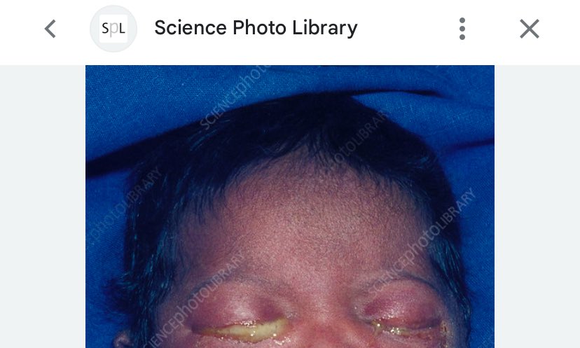 twitnyapimma's tweet photo. habis baca cerita seorang ibu yg bayinya lahir prematur, harus dirawat di NICU, dan mata bayi ny penuh nanah. ternyata ibunya kena gonore. beliau bahkan g sadar kalau udah tertular, cm ngerasa keputihannya nggak sembuh2 ps hamil

yang bikin sesek? ternyata slm istrinya hamil, suaminya malah "jajan" di luar, nggak berobat, terus infeksinya kebawa pulang ke istri…dan yes, secara medis hal kayak gini emang bisa terjadi ⬇️