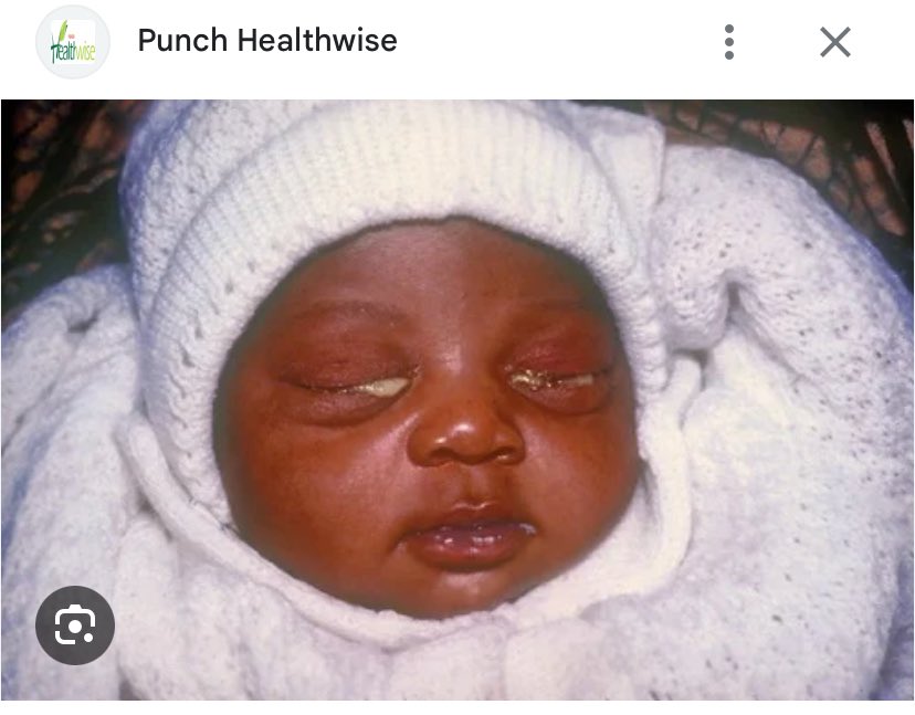 twitnyapimma's tweet photo. habis baca cerita seorang ibu yg bayinya lahir prematur, harus dirawat di NICU, dan mata bayi ny penuh nanah. ternyata ibunya kena gonore. beliau bahkan g sadar kalau udah tertular, cm ngerasa keputihannya nggak sembuh2 ps hamil

yang bikin sesek? ternyata slm istrinya hamil, suaminya malah "jajan" di luar, nggak berobat, terus infeksinya kebawa pulang ke istri…dan yes, secara medis hal kayak gini emang bisa terjadi ⬇️
