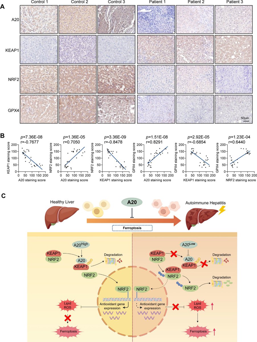 Gut_BMJ's tweet photo. How liver cells regulate inflammatory injury remains an area of intense investigation. 

Chen et al. present "A20-mediated KEAP1 ubiquitination orchestrates hepatocyte ferroptosis to ameliorate autoimmune hepatitis" via

https://t.co/Dn4Pzs72hX

This elegant mechanistic study identifies A20 as a key regulator of ferroptosis through modification of KEAP1, limiting liver injury in autoimmune hepatitis. The findings complement this issue's accompanying commentary and highlight ferroptosis as an increasingly important therapeutic target in immune-mediated liver disease.

#AutoimmuneHepatitis