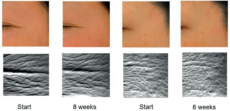 celestialbe1ng's tweet photo. Astaxanthin actually kills the enzyme that makes your wrinkles. Yes, really.

Despite what the raw milk anti-sunscreen types say, every time the sun hits your face, your skin sets off an inflammatory alarm and that alarm switches on an enzyme called MMP-1.

MMP-1 eats collagen. It's a shredder, and it has been running in your face on every sunny day of your life.

That's what a line is. Damage.

Astaxanthin shuts the alarm off before the shredder ever starts. In a 16 week trial, the women on placebo watched their deep wrinkles get deeper. The women on astaxanthin didn't budge.

It's a red pigment from algae. 12mg a day. Cheaper than your coffee habit.

P.S.: yes, the sun is essential and life-giving, and we need hours of it every day to function optimally. But it also ages your skin. Two things can be true at the same time.

My tips:

• get the morning and late afternoon light primarily (that light is the most beneficial anyway)
• clean sunscreen when the sun is very harsh
• pop an aspirin 30 min before any tanning session
• don’t consume seed oils/PUFA
• collagen with vitamin C (from acerola cherry, never synthetic ascorbate... Aurabiōm collagen+natural C will be available in a couple of weeks, stay tuned:))
• vitamin C serum: again, wait for Aurabiōm's, it will be mind-blowing (coming out next month!)
• vitamin E
• astaxanthin supplementation 

Okay, love you, bye xxx💙