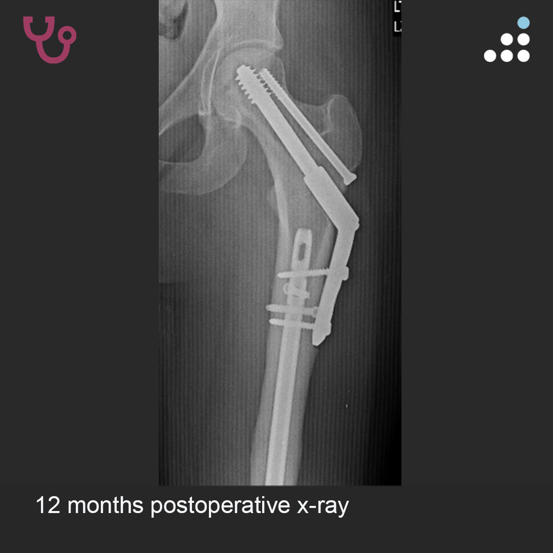 orthobullets's tweet photo. Here are intraop & postop images of yesterday's case by Dr. Michael Makowski and @ClevelandClinic.

HUMERAL SHAFT FX W/ CONTRALATERAL COMPLEX FEMUR FX IN 24F

PROCEDURE: 1. ORIF with Retrograde IMN of Segmental Femur Fx
2. ORIF of Femoral Neck Fx with Sliding Hip Screw and Derotational screw
3. ORIF of Humeral Shaft Fx with Dual Plating

Here is the link to the clinical presentation and the pre-op imaging: https://t.co/C1byT65nDL

Do you agree with the treatment? Why or why not?

Leave a comment and keep the great conversation going! #orthotwitter

Vote on this case for CME: https://t.co/VwL4QJeAR0