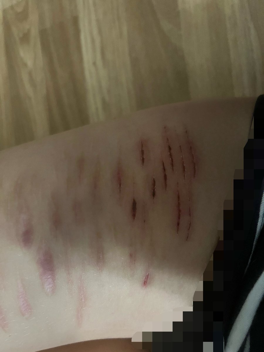 skruvo's tweet photo. sfx makeup
all scabbed up😈😈 https://t.co/XPCu2MhQH1