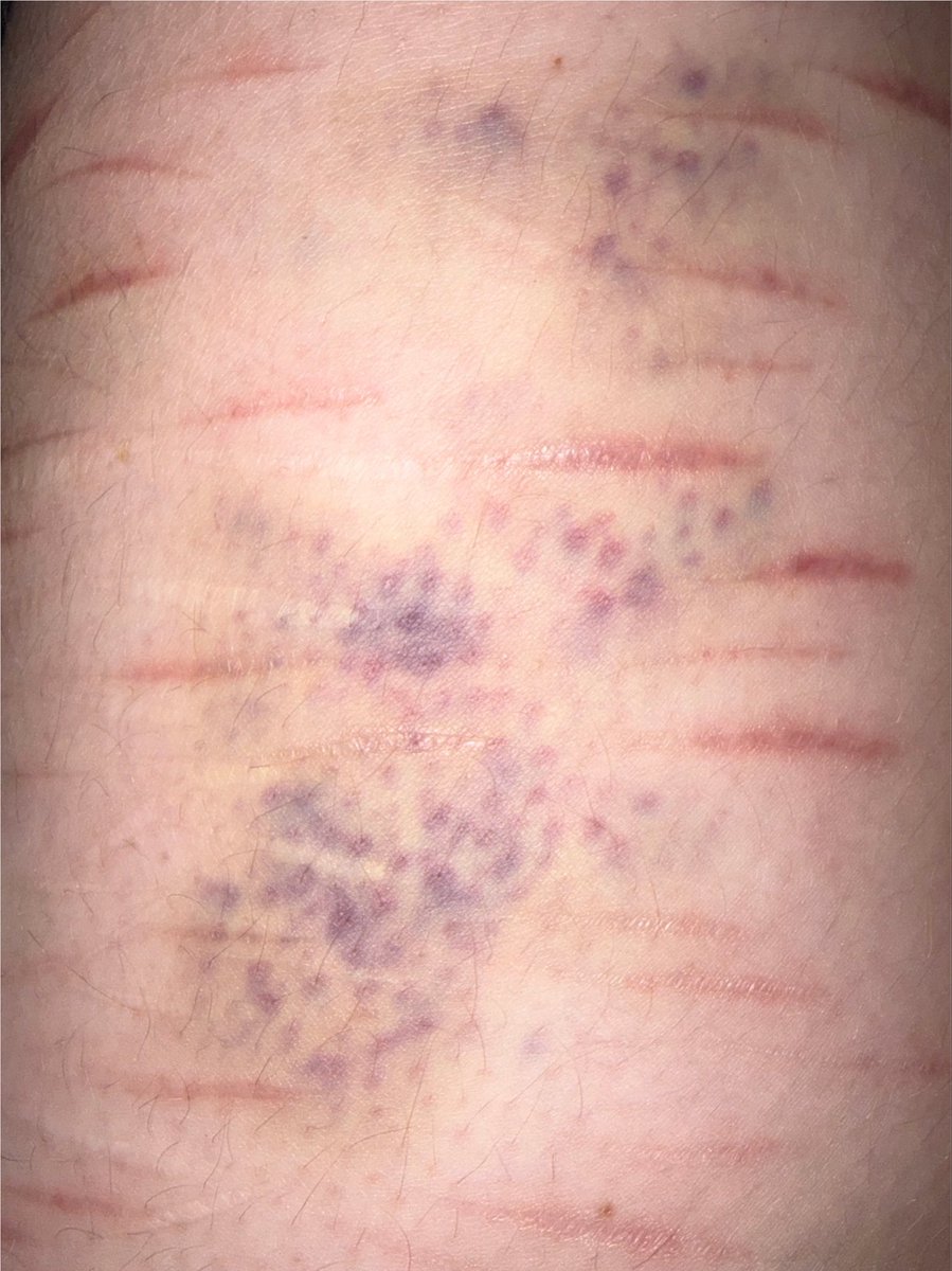 c0ff33syrup's tweet photo. my bruise looks like purple mold https://t.co/uB0hIqXFiq