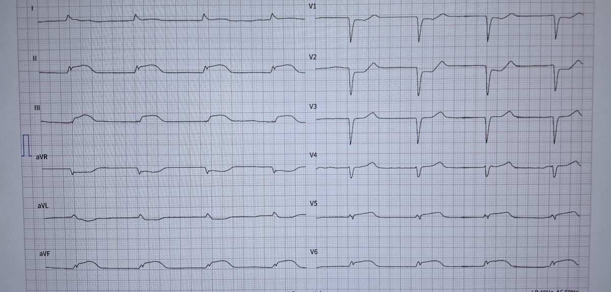 OnlyEcg1's tweet photo. Acute Chest pain. Full dx?

#Cardiovascular #MedicalStudents #MedicalEmergency #MedicalEducation #EPS #EPeeps_bot #CardioEd #Cardiologist #Paramedics #EKG #ECG #Cardiology #CardioTwitter #MedTwitter #MedicalCase #MedicalQuiz #STEMI #OMI #CathLab #QoHBot https://t.co/aQVC9qO6QO