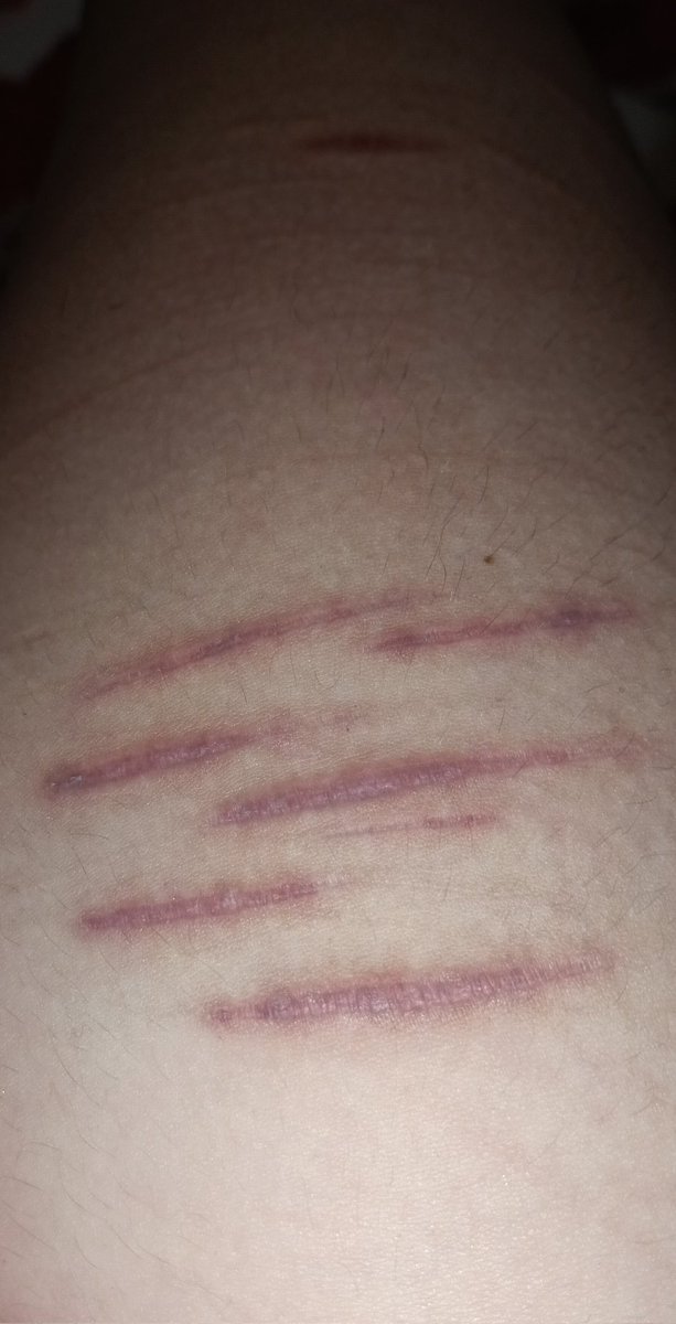 Ashero1k's tweet photo. I've always wondered why my scars looked like this after a shower 
#shedtwt #shtwt #slittwt https://t.co/xjQbsdEhwY