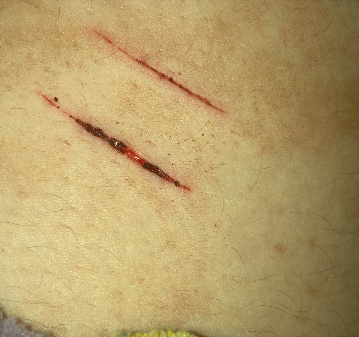 _ScarsOfVenus_'s tweet photo. (fake body fake everything trust) healing check.. 

i kinda might not wait to cut back over it call me a masochist but i want it to be sensitive when i open it back up 🤤 https://t.co/GWiuLlT82a