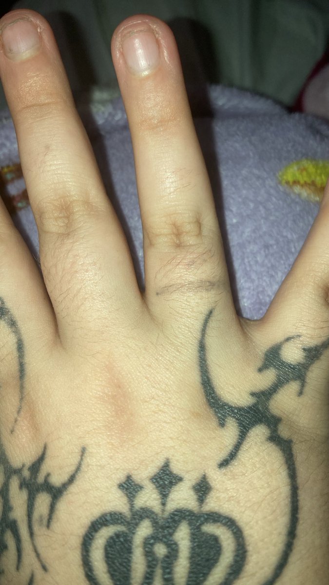 _ScarsOfVenus_'s tweet photo. my other sh method might be the best thing ever bc if i feel like it í just give myself temporary stick and poke tattoos minus the ink the blood does the art for me

that or i genuinely do a bad tat on myself with my tattoo gun

(yes i plan to fix them someday) https://t.co/KzjPMwQP5A
