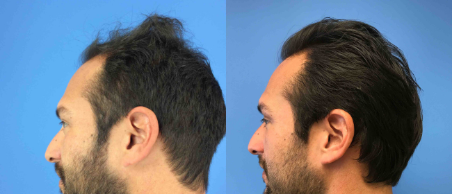 CosmetiCare's tweet photo. Before and after of Hair Restoration ✨

Schedule your consultation with one of our Board-Certified plastic surgeons today by calling 949-446-1542! https://t.co/ElMPSNbJWw