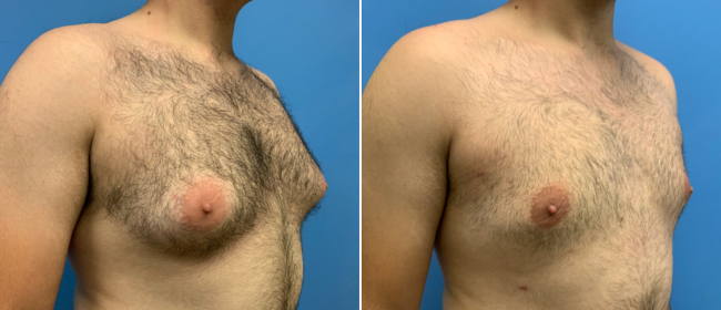 CosmetiCare's tweet photo. Before and after of Liposuction ✨

Schedule your consultation with one of our Board-Certified plastic surgeons today by calling 949-446-1542! https://t.co/DnPUyWZdqG