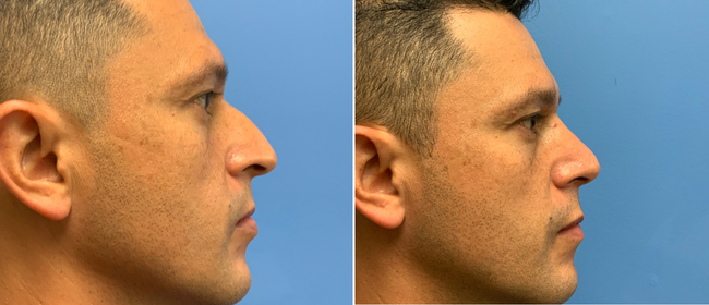CosmetiCare's tweet photo. Before and after of a Rhinoplasty! ✨

Schedule your consultation with one of our Board-Certified plastic surgeons today by calling 949-446-1542! https://t.co/iSUNNeuUFM