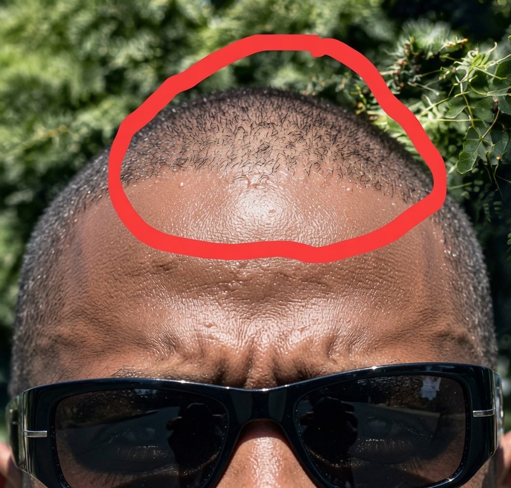 BarbzzRus's tweet photo. Forehead just looks nasty 🤢 What a coincidence, after the haircut we see grey hairs and bald spots 🤣 #LaceZ https://t.co/dQdObZpcv0